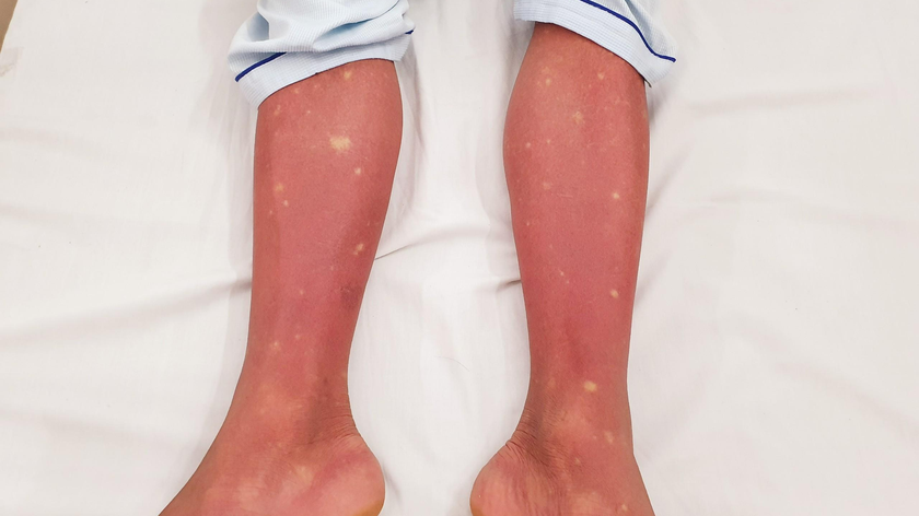 Hình ảnh xuất huyết trên chân của bệnh nhân sốt xuất huyết - Ảnh: BVCC