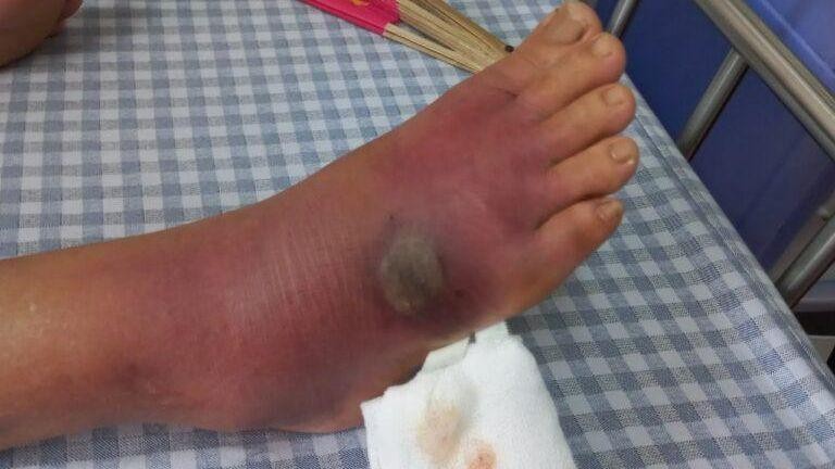 Hình ảnh khi người bệnh vào viện sưng tấy lan tỏa toàn bộ mu chân lên cổ chân, tại trung tâm vết cắn đang có dấu hiệu hoại tử ướt. Ảnh: BVCC