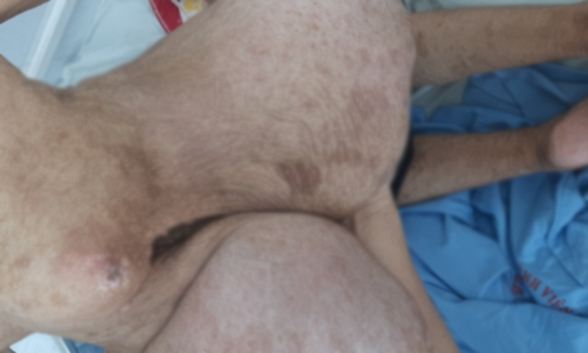 Hình ảnh khối u trên lưng bệnh nhân (Ảnh: BVCC)