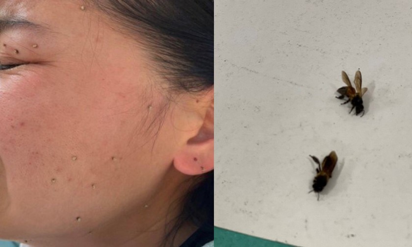 Vết ong đốt để lại ngòi trên vùng đầu, mặt, cổ của bệnh nhân và xác ong. Ảnh: BVCC