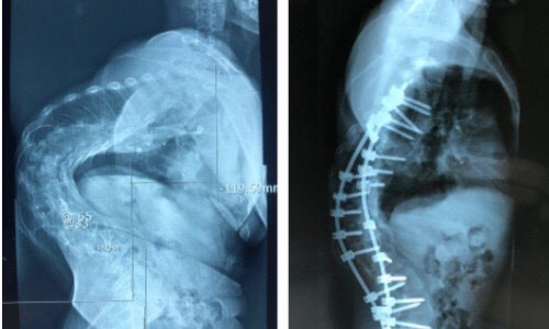 Phim chụp X - quang trước và sau phẫu thuật nắn chỉnh gù.