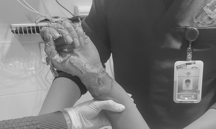 Bàn tay của nạn nhân sau khi bị bỏng.