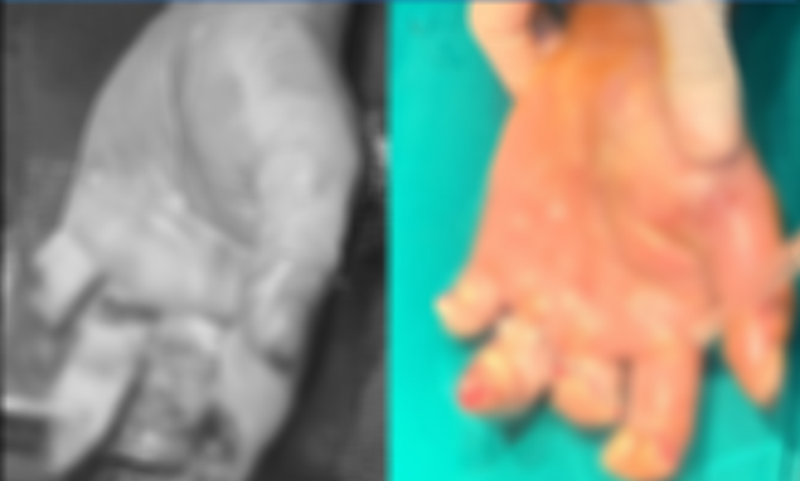 Vết thương phức tạp bàn tay trái của bệnh nhân Đ.V.S (31 tuổi).