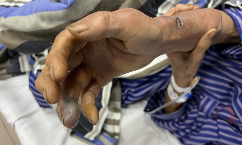 Bệnh nhân bị rắn hổ mang bành cắn vào tay. Ảnh: BVCC
