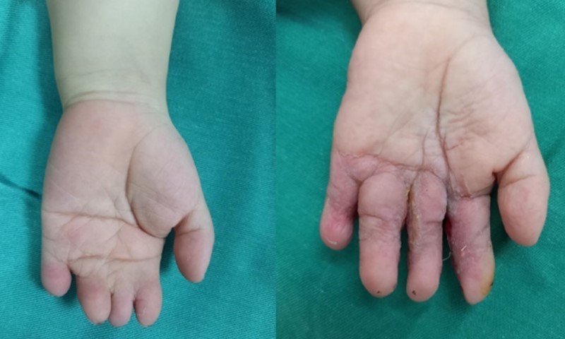 Hình ảnh tay bệnh nhi trước và sau phẫu thuật. Ảnh: BVCC