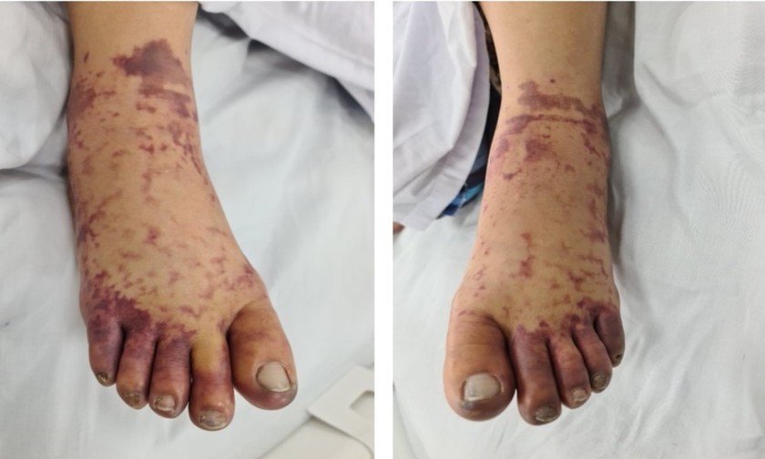 Hình ảnh bàn chân của bệnh nhân ngày thứ 2 nhập viện. Ảnh: BVCC