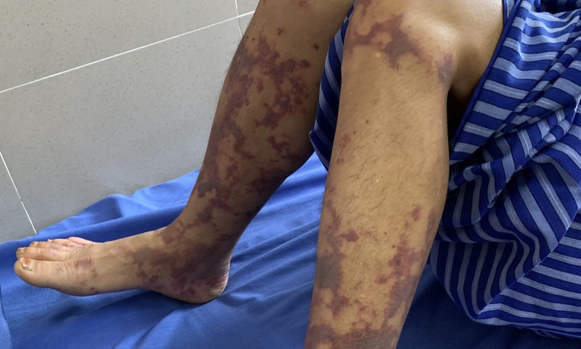 Ban xuất huyết hoại tử màu tím đen trên chân bệnh nhân. Ảnh: BVCC