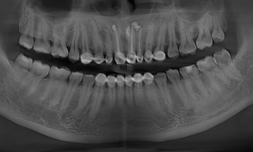 Hình ảnh chất hàn thừa vùng răng 21, nang xương hàm trên vùng cửa. Ảnh: BVCC