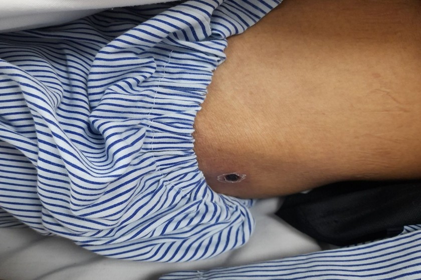 Vết thương do mò đốt ở vùng mông bên trái của bệnh nhân. 