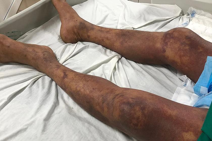 Hình ảnh chân bệnh nhân tím đen do xuất huyết hoại tử. Ảnh: BVCC