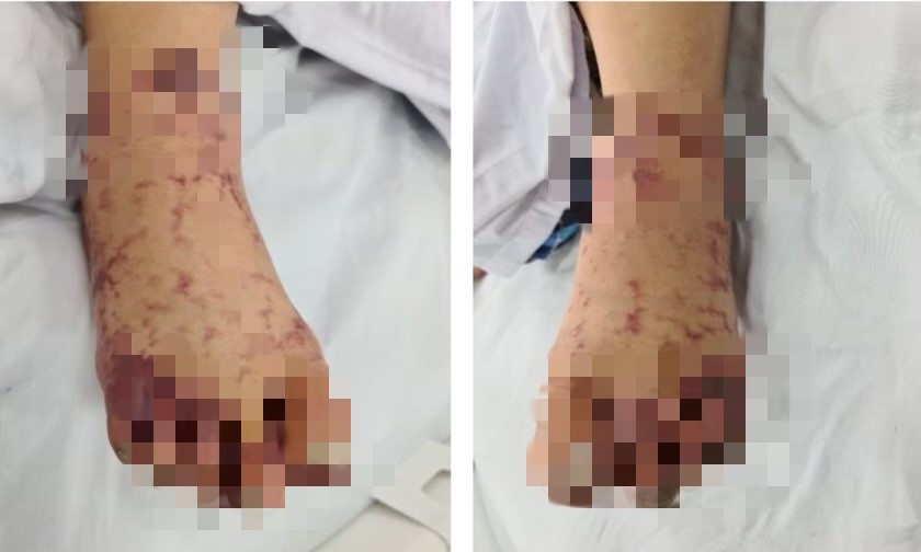Hình ảnh xuất huyết bàn chân của một bệnh nhân mắc liên cầu lợn.