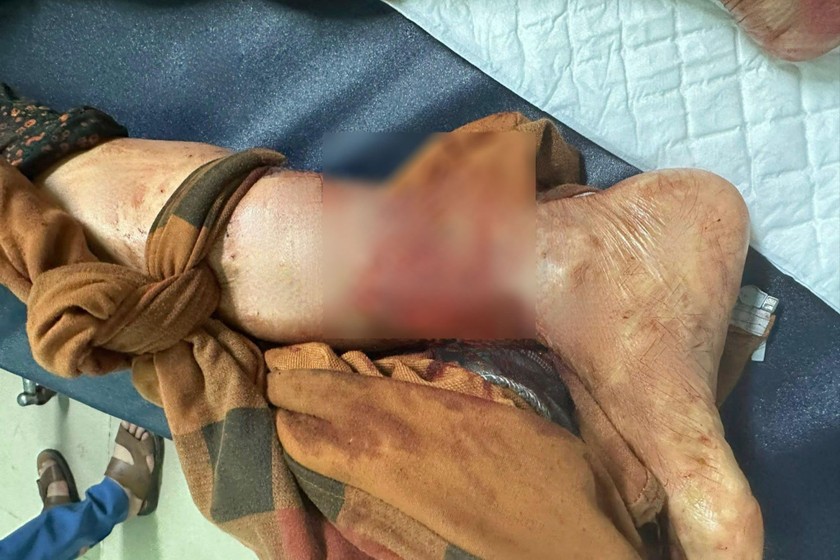 Tình trạng bàn chân của bệnh nhân sau khi bị chó cắn. Ảnh: BVCC