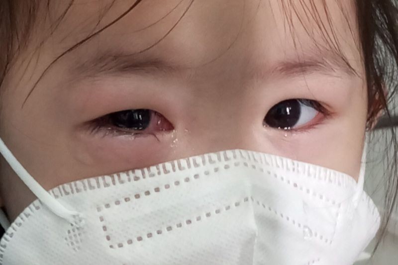 Trẻ bị sưng nề, nước mắt chảy dịch hồng do bệnh đau mắt đỏ.