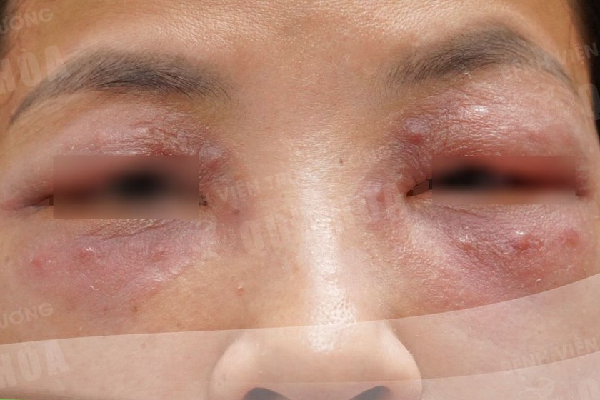 Tình trạng kích ứng quanh vùng mắt của bệnh nhân.