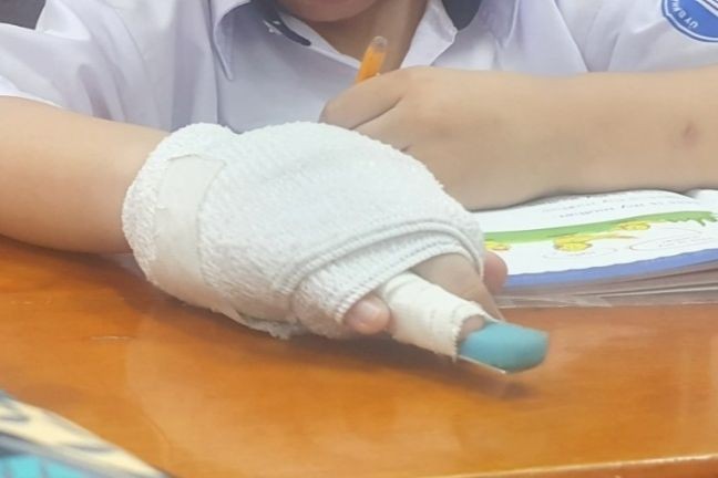 Bàn tay phải của học sinh được băng bó. Ảnh: VnExpress