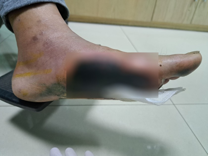 Tình trạng bàn chân của bệnh nhân bị hoại tử.