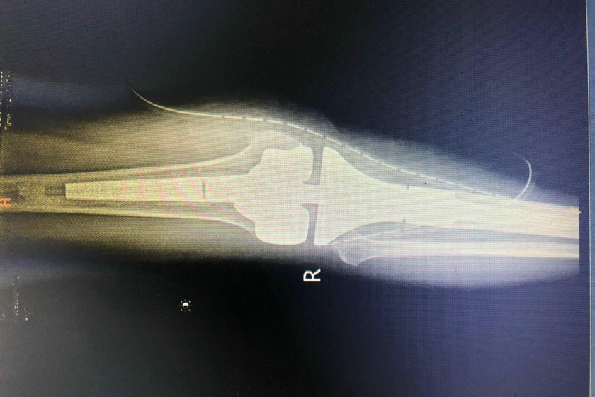 Hình ảnh chụp X quang chụp khối y xương của bệnh nhân. Ảnh: 