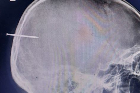 Hình ảnh chụp chiếc đinh sắt găm trên đầu người bệnh.