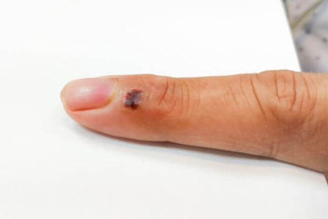 Vết thương do mèo cắn ở ngón trỏ tay trái của anh H. Ảnh: BVCC