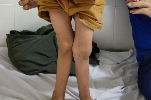 Hình ảnh đôi chân của bệnh nhi. Ảnh: BVCC