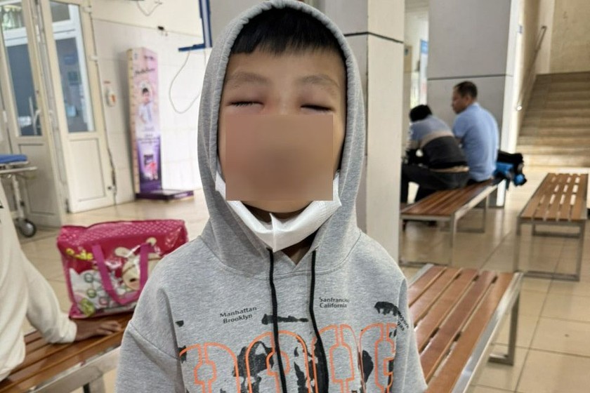 Trẻ đến viện khám trong tình trạng mắt sưng nề, không mở được mắt. Ảnh: BVCC