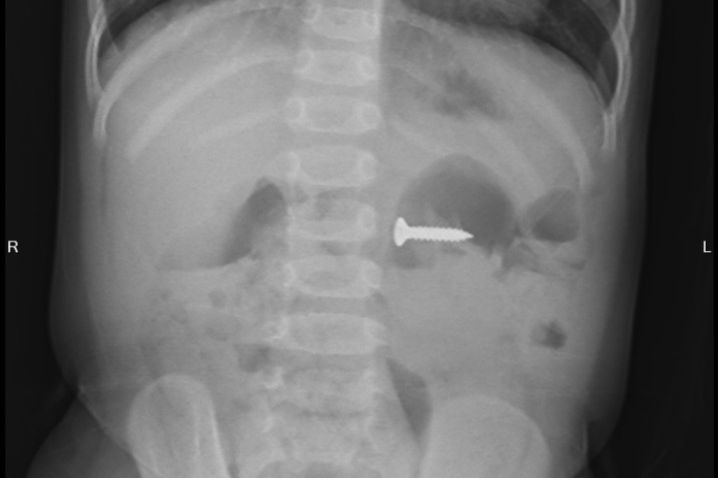 Hình ảnh chụp X-quang chiếc đinh nằm trong người bệnh nhi.