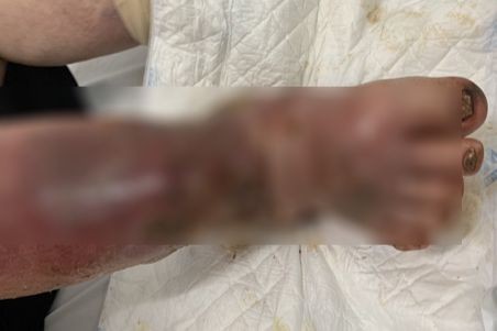 Tình trạng chân của bệnh nhân khi đến viện. Ảnh: BVCC