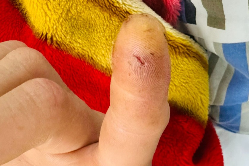 Vết thương ở đầu ngón tay bệnh nhân sau khi bị culi cắn.