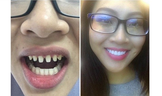 Hình ảnh trước và sau khi sửa răng của Diệu Ngọc do người tố cáo đăng tải trên mạng xã hội. Ảnh: Chụp màn hình.