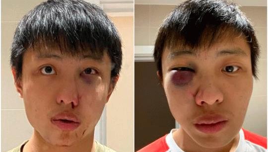 Jonathan Mok đăng 2 bức ảnh của mình cho thấy mắt trái bị sưng. Ảnh: Facebook/Jonathan Mok.