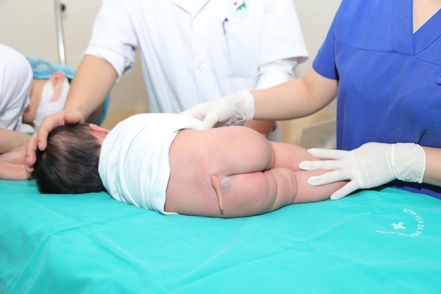 bệnh nhân Phạm D.G.H, 5 tháng tuổi trước khi phẫu thiataj cắt bỏ di tật còn đuôi bẩm sinh.
