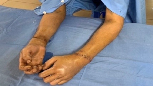 2 bàn tay đứt rời của bệnh nhân đã được các bác sĩ nối lại thành công. Ảnh: BVCC