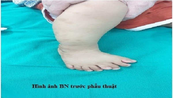 Bé trai 1 tuổi bị dị tật phức tạp, bàn chân phải có 9 ngón. Ảnh: BVCC