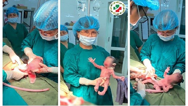 Đây là ca sinh 3 cùng trứng hy hữu tại Bệnh viện Đa khoa tỉnh Tuyên Quang. Ảnh: BVCC