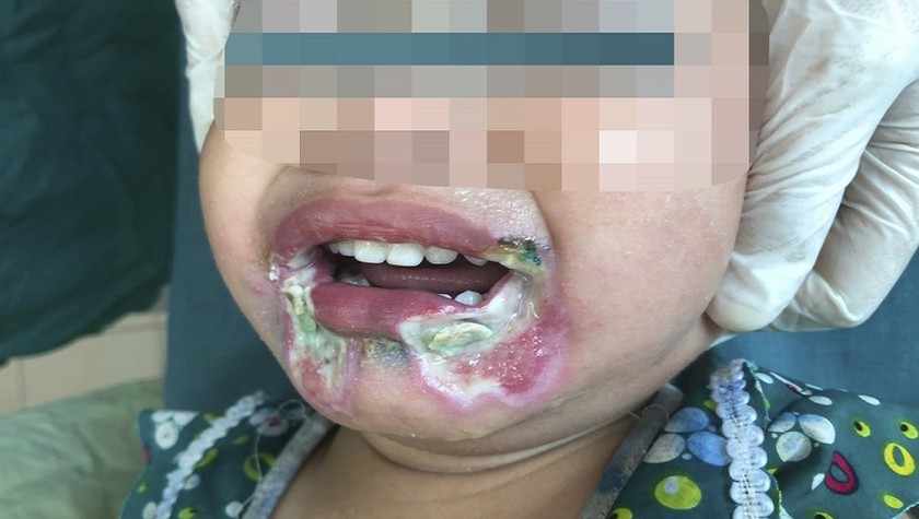 Tổn thương bỏng vùng miệng của cháu bé do dòng điện khi vào viện. Ảnh: BVCC