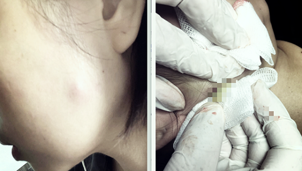 Ổ áp xe sau khi tiêm botox không rõ nguồn gốc trên mặt nữ bệnh nhân (ảnh: Bác sĩ cung cấp)
