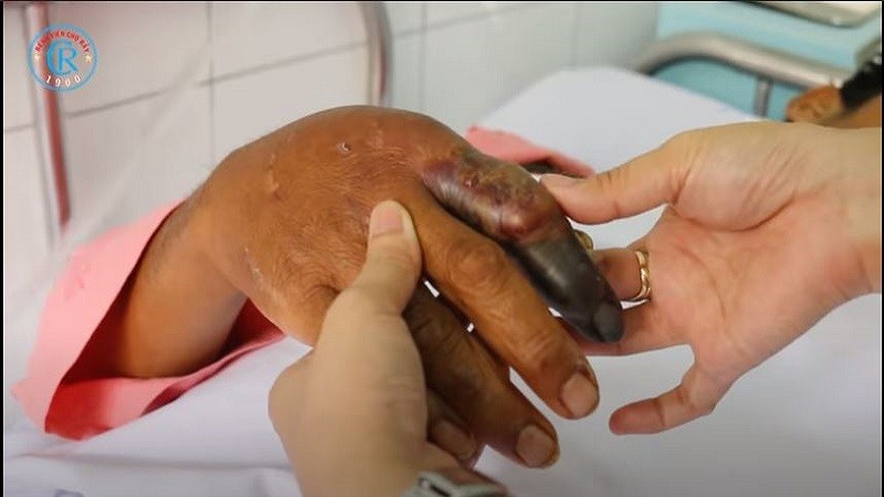 Vết cắn của rắn hổ chúa trên tay bệnh nhân. Ảnh: BVCC