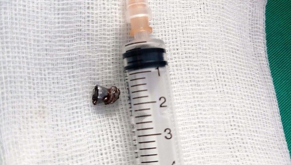 Dị vật là viên đạn chì được lấy ra khỏi người bệnh nhân (ảnh: BVCC)