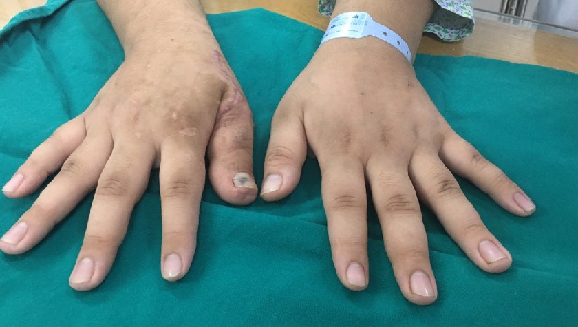 Bàn tay của bệnh nhân T. khi được cấy ghép da.