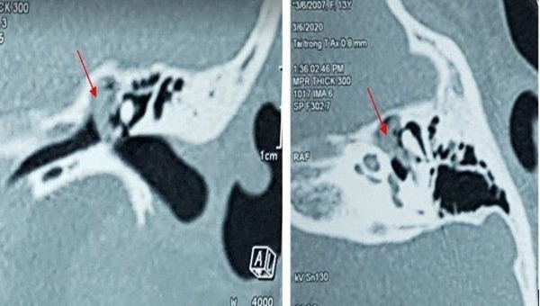 Hình ảnh cắt lớp vi tính: khối cholesteatoma ăn mòn xương con và lan rộng trong tai giữa trái (ảnh: BVCC)