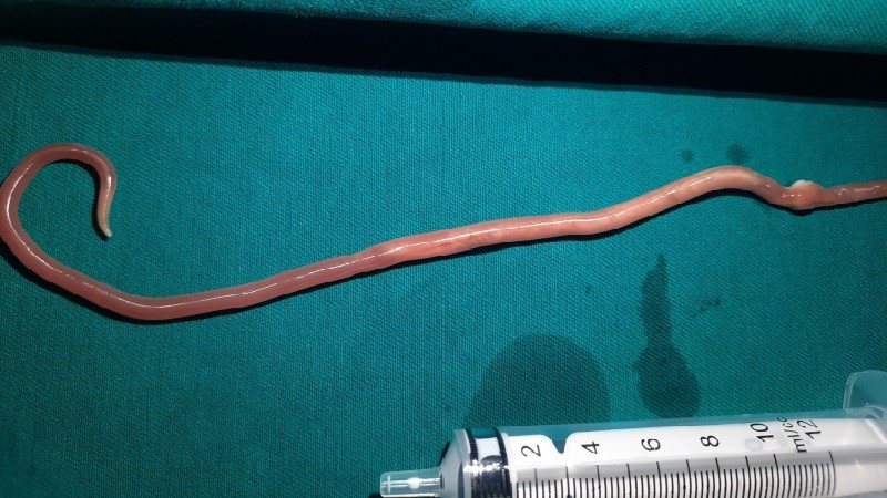 Hình ảnh giun đũa dài 25cm lấy ra từ ống mật chủ của người bệnh (Ảnh: BVCC)