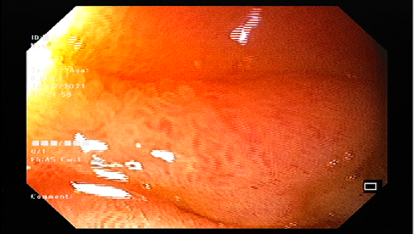 Hình ảnh nội soi hàng trăm con giun tóc trong ruột bệnh nhân (ảnh: BVCC) 