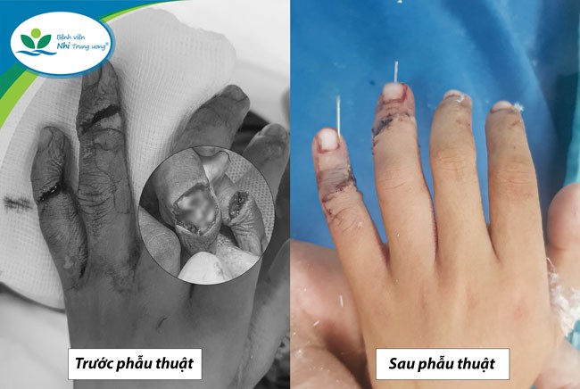 Phụ anh nấu ăn, bé trai 7 tuổi ở Quảng Ninh gần đứt rời 2 ngón tay 