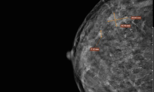 Hình ảnh chụp X-quang cho thấy hiện tượng vi vôi hóa lan tỏa tuyến vú phải .
