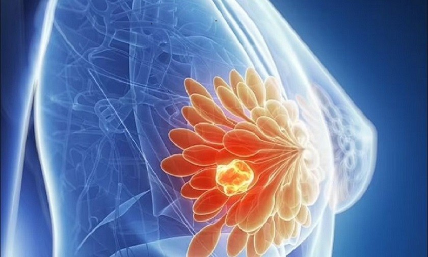 Khi thấy khối bất thường ở vùng vú có thể là dấu hiệu ung thư vú đã di căn.
