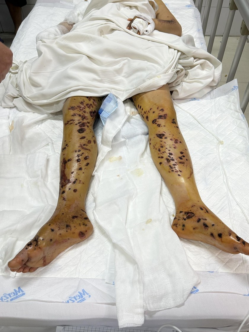 Vùng chân người bệnh bị tổn thương do điện thoại nổ khi đang sạc. Nguồn ảnh BVCC