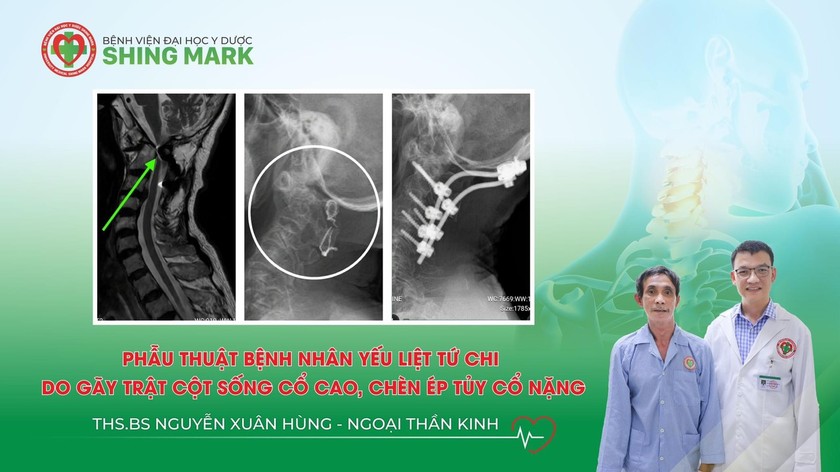 Bệnh viện Đại học Y dược Shing Mark phẫu thuật thành công cứu bệnh nhân yếu liệt tứ chi