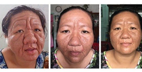 Khuôn mặt chị Thạch Thị Tha Ri bị lão hóa sau khi dùng mỹ phẩm.