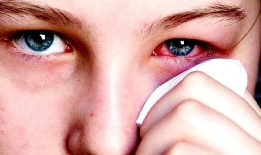 Những điều bạn cần biết về đau mắt đỏ