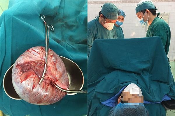 Các y bác sĩ phẫu thuật cắt khối u nang buồng trứng khủng cho chị HTĐ.